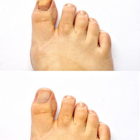 before-after-toenail-healing