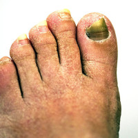 foot-with-damaged-nail