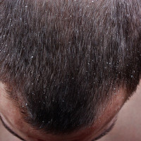 psoriasis-in-hair