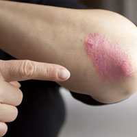 A person near Jacksonville, NC, who needs psoriasis skin treatment