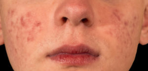 Young Woman with Acne — New Bern, NC — East Carolina Dermatology and Skin Surgery, PLLC