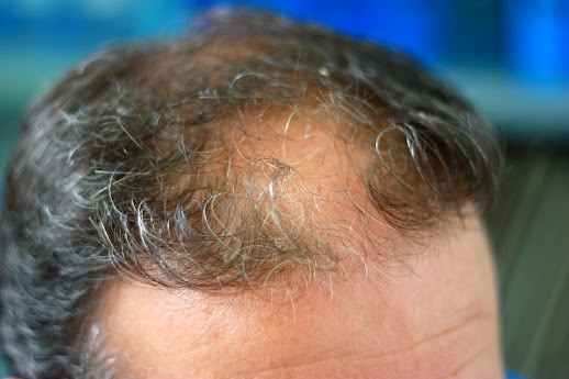Premature Balding | East Carolina Dermatology and Skin Surgery