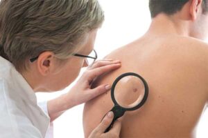Dermatologist Examines a Spot of Male Patient — New Bern, NC — East Carolina Dermatology and Skin Surgery, PLLC