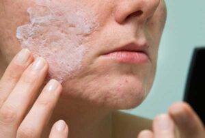 Cream Applying to Skin with Acne Scars — New Bern, NC — East Carolina Dermatology and Skin Surgery, PLLC